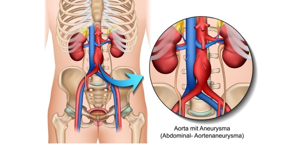 Getting Familiar with Abdominal Aortic Aneurysm