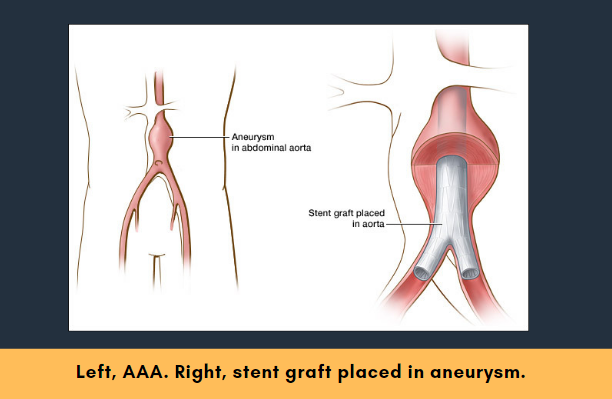 Abdominal Aortic Aneurysms
