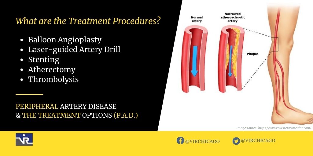 Peripheral Artery Disease and What are the Treatment Options