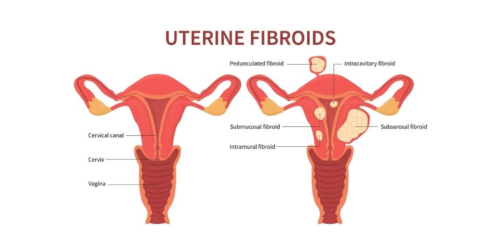 A Few Facts About Uterine Fibroids